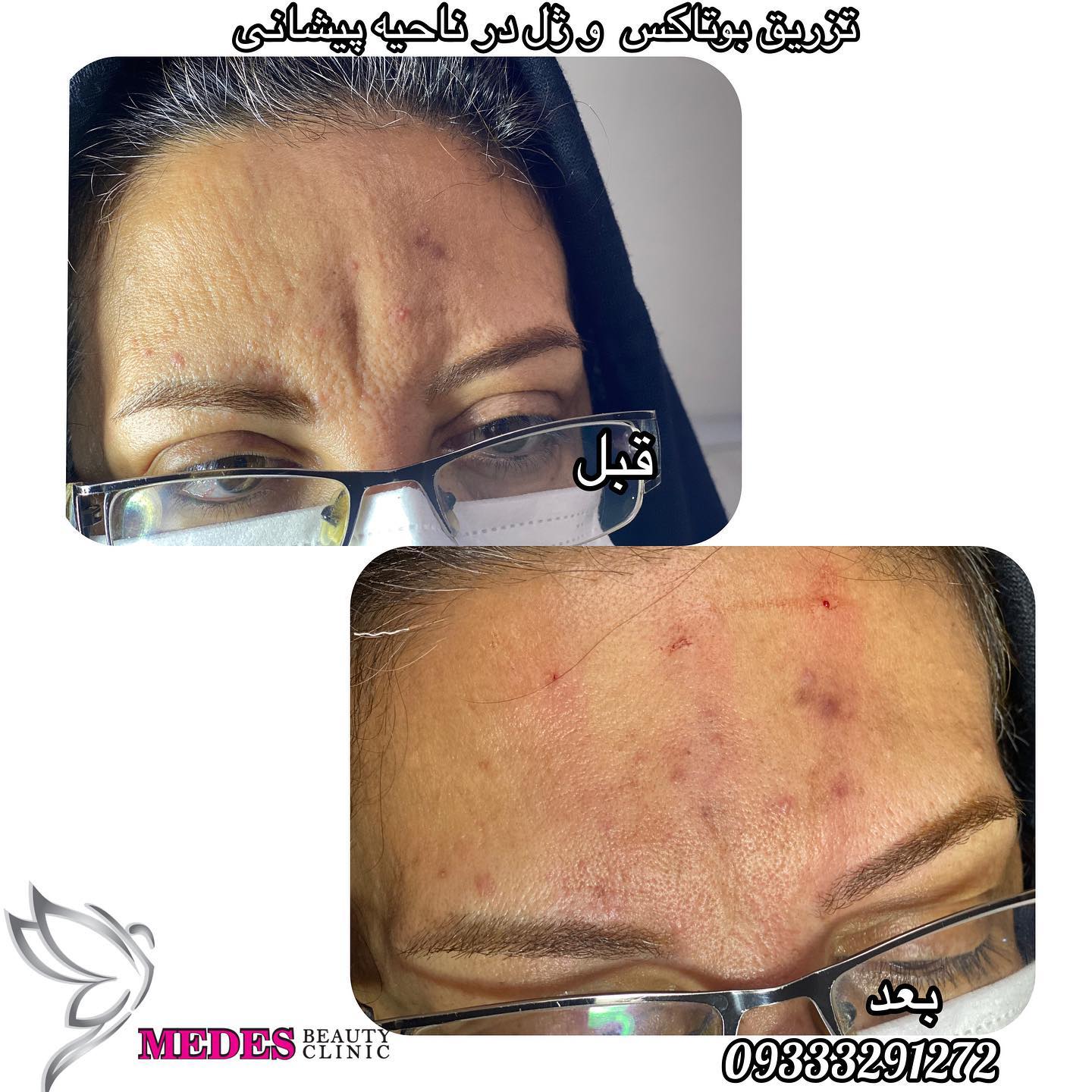 گالری تزریق بوتاکس